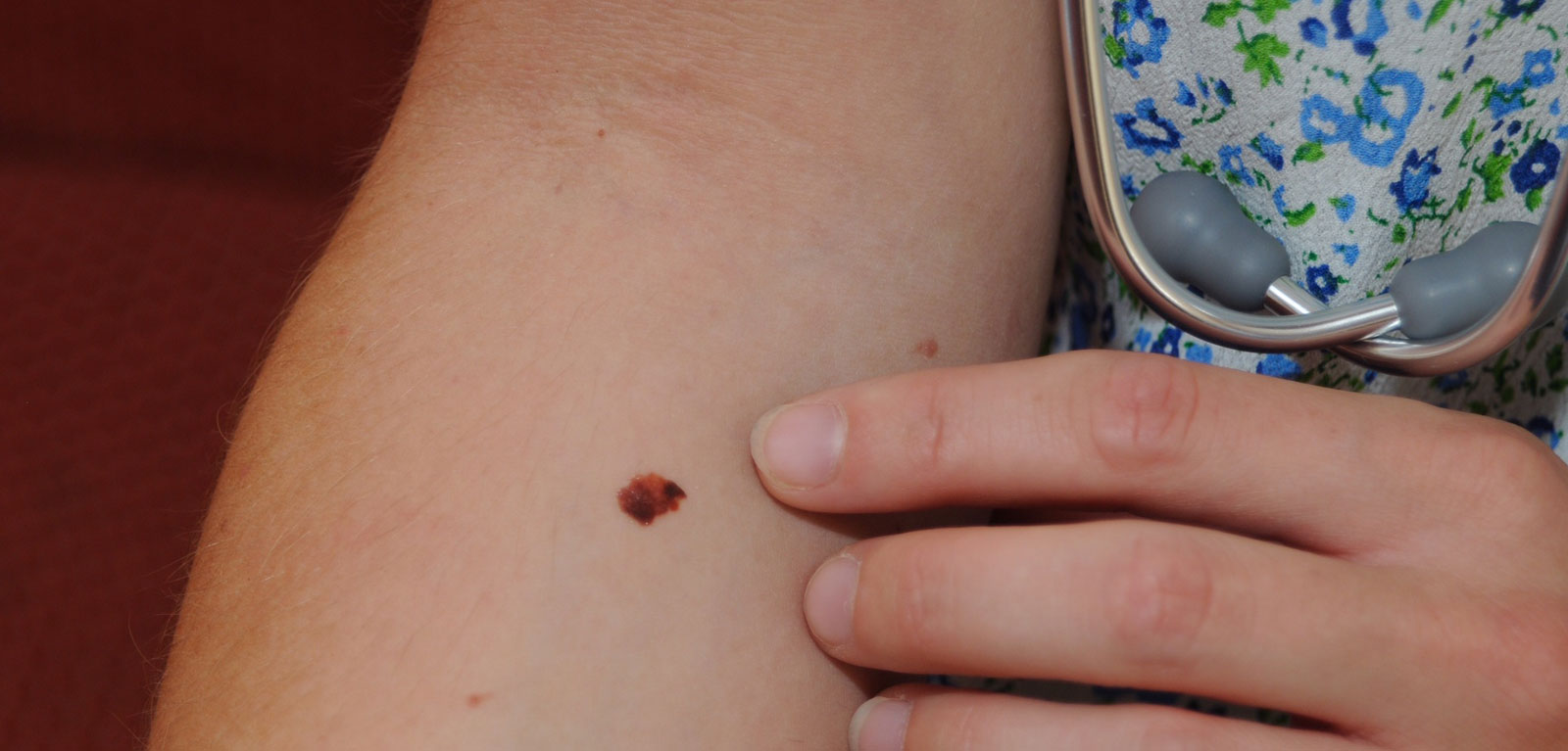 Melanoma transfer tattoo