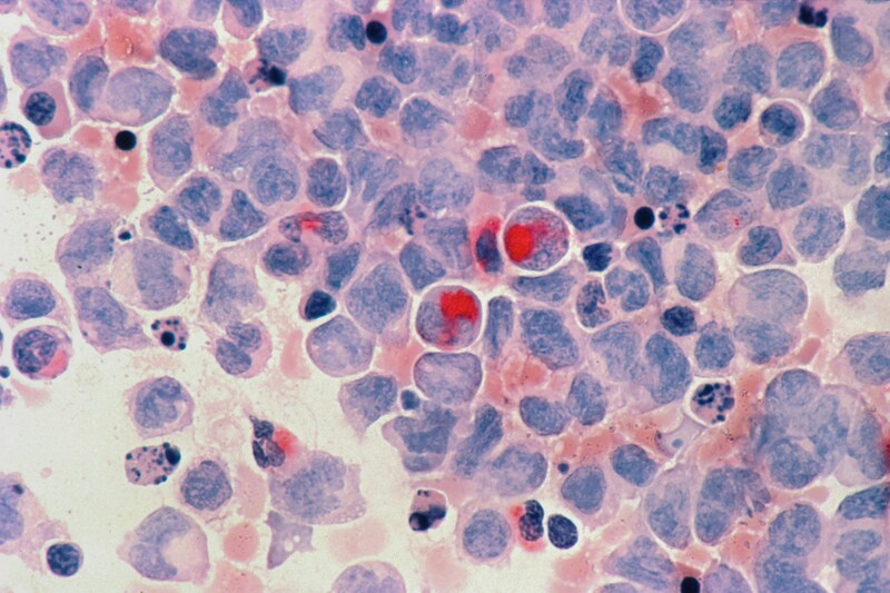Acute myelocytic leukaemia (AML) cells