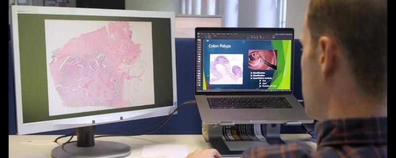 Researcher reviewing digital pathology slides showing colon polyps on two computer screens, demonstrating AI-assisted medical image analysis