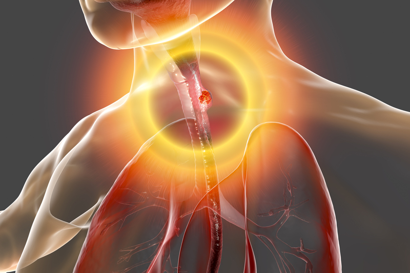 Oesophageal cancer