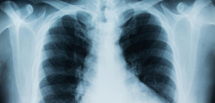 lungs, cancer, xray